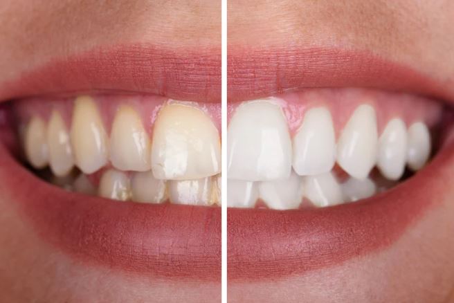 CDCwebsite2024_familydentistry_teethwhitening