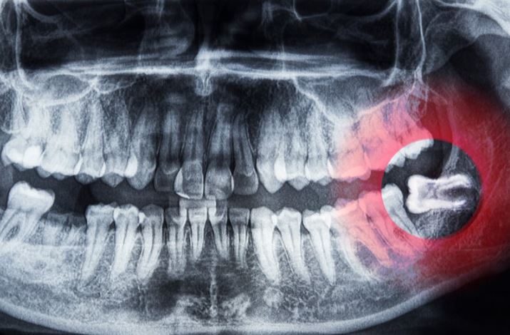 CDCwebsite2024_familydentistry_wisdomteethextractions