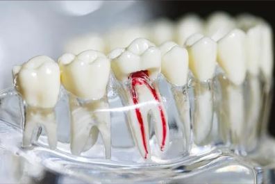 CDCwebsite2024_restorative_rootcanals