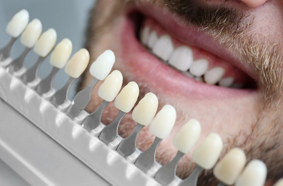 cdc_website_cosmeticdentistry_veneers