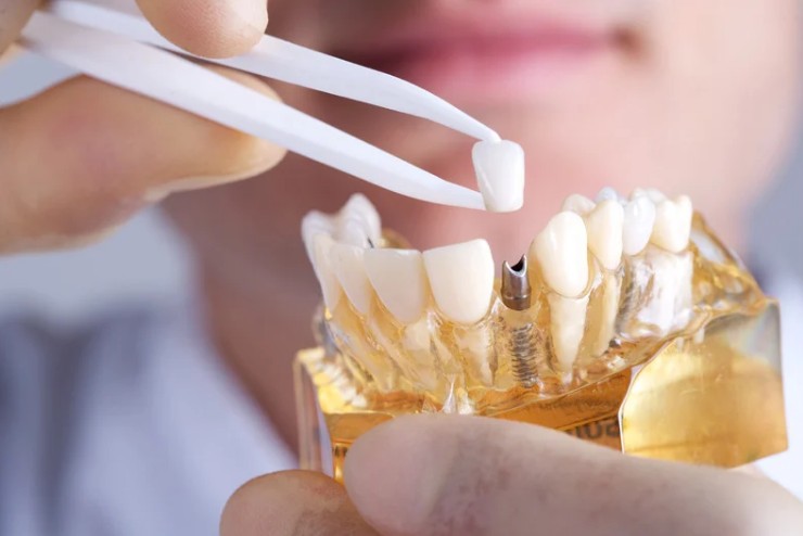 cdc_website_restorativedentistry_implantpic